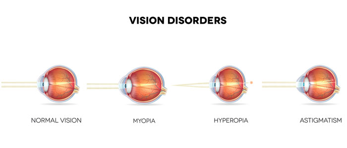 Eye diagram showing the differences between normal vision, myopia, hyperopia, and astigmatism